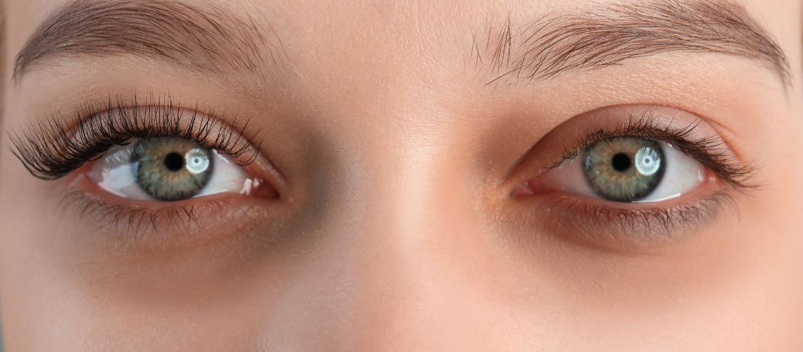 Göz Altı Çökmesi ve Çukurları Nasıl Geçer?